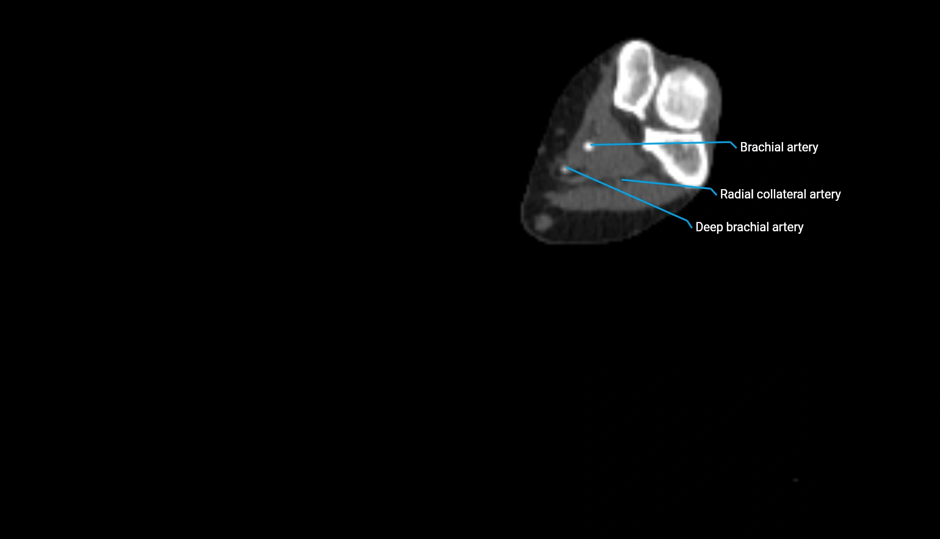 CTA upper limb axial cross sectional anatomy labelled image 193 (2).webp